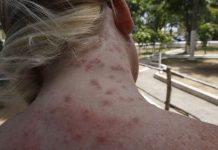 ¿Conoces los daños qué causa en la piel la palometa peluda?