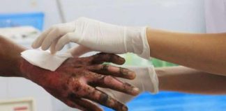 Ellos sufrieron quemaduras en La Comunidad Cardón