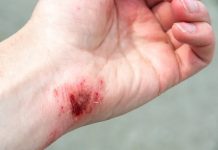 Adolescente llevó sus golpes en deslizamiento de moto en Píriitu