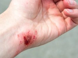 Adolescente llevó sus golpes en deslizamiento de moto en Píriitu