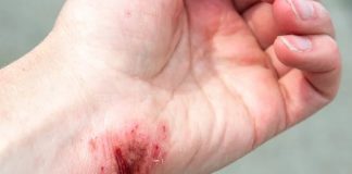 Adolescente llevó sus golpes en deslizamiento de moto en Píriitu