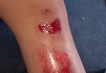 Mujer se raspó la pierna al caer de una moto