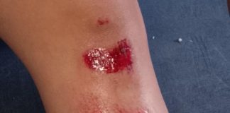 Mujer se raspó la pierna al caer de una moto