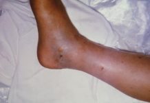 Estudiante es mordido por una serpiente en Tocopero