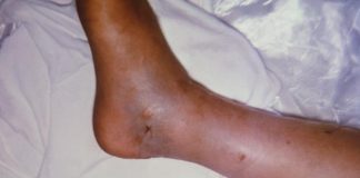 Estudiante es mordido por una serpiente en Tocopero