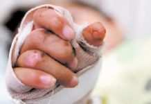 Niño sufrió quemaduras en un 18% de su superficie corporal en Urumaco