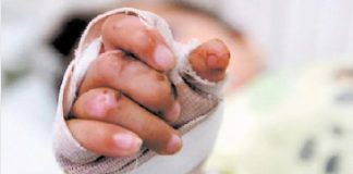 Niño sufrió quemaduras en un 18% de su superficie corporal en Urumaco