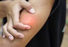 Dos lesionados por picaduras de abejas en Blanquita de Pérez