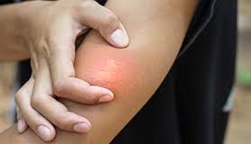 Dos lesionados por picaduras de abejas en Blanquita de Pérez