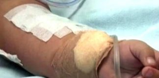 Niño de dos años sufrió quemaduras en Coro