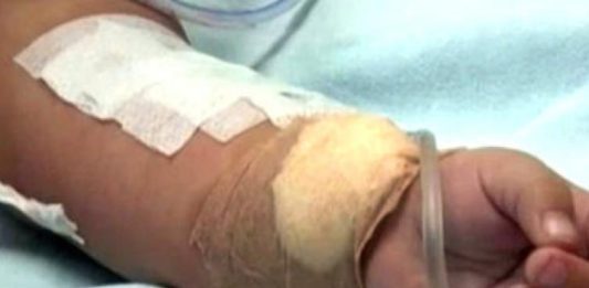 Niño de dos años sufrió quemaduras en Coro