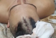 Agredió a su hermano de un machetazo en la cabeza
