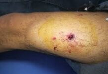 Herido hombre por proyectil de arma de fuego en Píritu