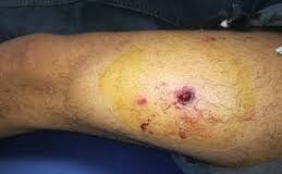 Herido hombre por proyectil de arma de fuego en Píritu