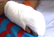 Trabajador recibió descarga eléctrica en Punto Fijo cuando colocaban un poste