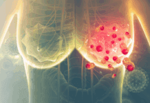 Venezuela: 10 personas al día mueren a consecuencia del cáncer de mama