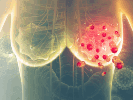 Venezuela: 10 personas al día mueren a consecuencia del cáncer de mama