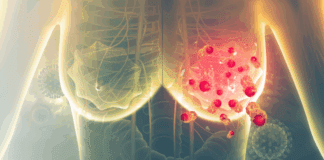 Venezuela: 10 personas al día mueren a consecuencia del cáncer de mama