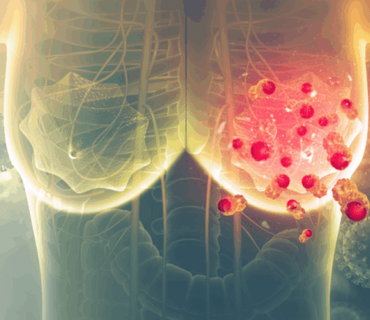 Venezuela: 10 personas al día mueren a consecuencia del cáncer de mama