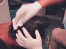 Punto Fijo| Adolescente sufrió un botellazo en la cabeza