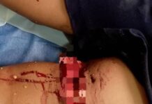 Fotos| Municipio Falcón| Adolescente es atacado por un pitbull