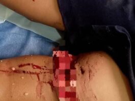 Fotos| Municipio Falcón| Adolescente es atacado por un pitbull