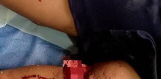 Fotos| Municipio Falcón| Adolescente es atacado por un pitbull