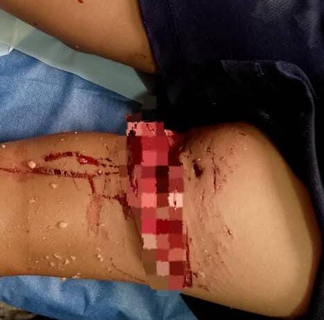 Fotos| Municipio Falcón| Adolescente es atacado por un pitbull