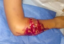 Adolescente se recupera de ataque de pitbull