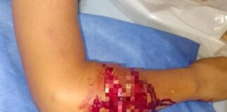 Adolescente se recupera de ataque de pitbull