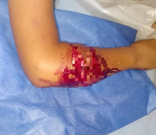 Adolescente se recupera de ataque de pitbull