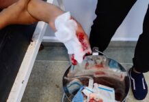 Dabajuro| Niño sufrió traumatismo en mano izquierda mientras manipulaba «tumba rancho»