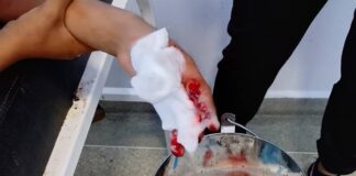 Dabajuro| Niño sufrió traumatismo en mano izquierda mientras manipulaba «tumba rancho»