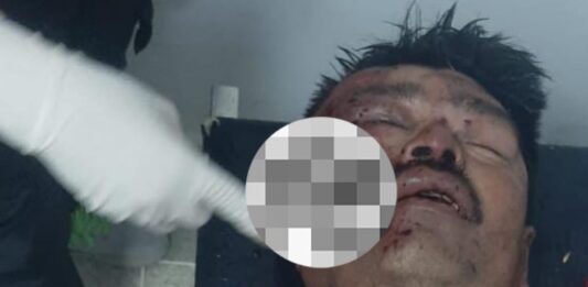 Pescador resultó herido tras accidente vial en la Carretera Falcón-Zulia