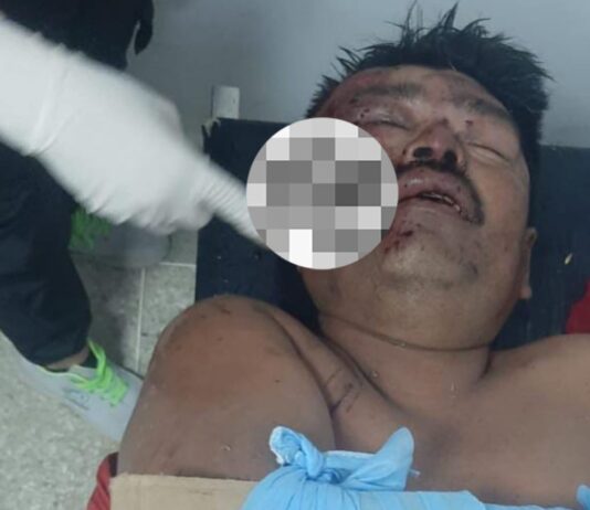 Pescador resultó herido tras accidente vial en la Carretera Falcón-Zulia