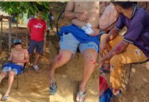Explosión de neumático ocasiona deslizamiento de moto y deja dos lesionados en la Morón -Coro
