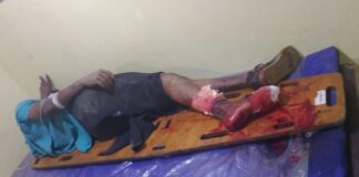 Hombre de 50 años sufre graves fracturas tras deslizar en su moto en San Pedro de Adicora