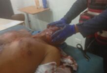 Madrugada trágica en la Morón-Coro: motorizado resultó herido tras deslizamiento en Tucacas